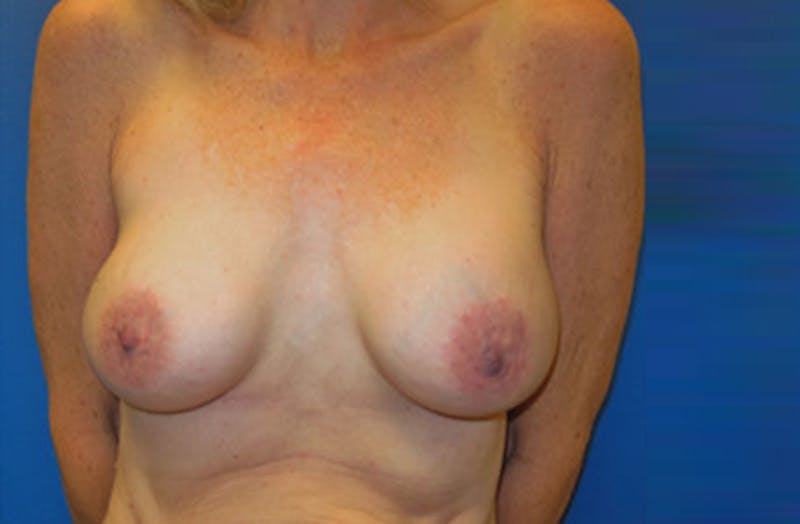 Breast Augmentation Revision Before & After Gallery - Patient 947553 - Image 1