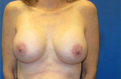 Breast Augmentation Revision Before & After Gallery - Patient 947553 - Image 2
