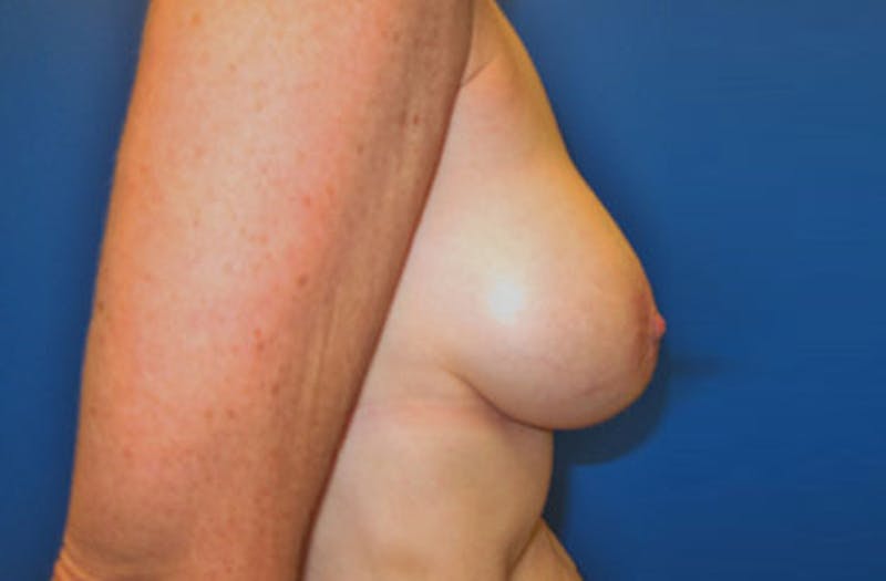 Breast Augmentation Revision Before & After Gallery - Patient 947553 - Image 3