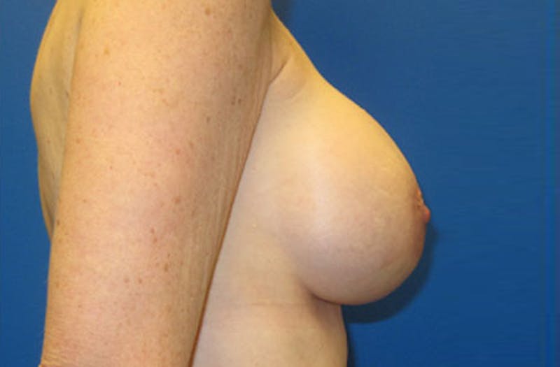Breast Augmentation Revision Before & After Gallery - Patient 947553 - Image 4