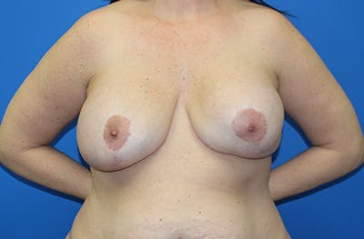 Breast Augmentation Revision Before & After Gallery - Patient 356588 - Image 1