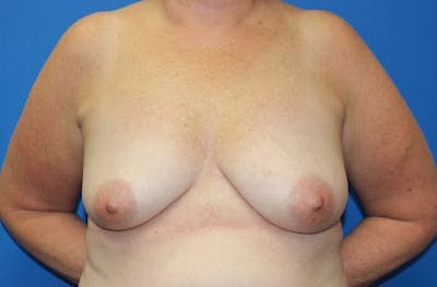 Breast Lift With Augmentation Before & After Gallery - Patient 418098 - Image 1
