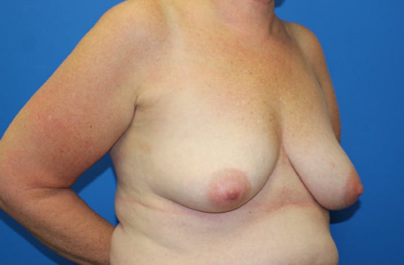 Breast Lift With Augmentation Before & After Gallery - Patient 418098 - Image 3