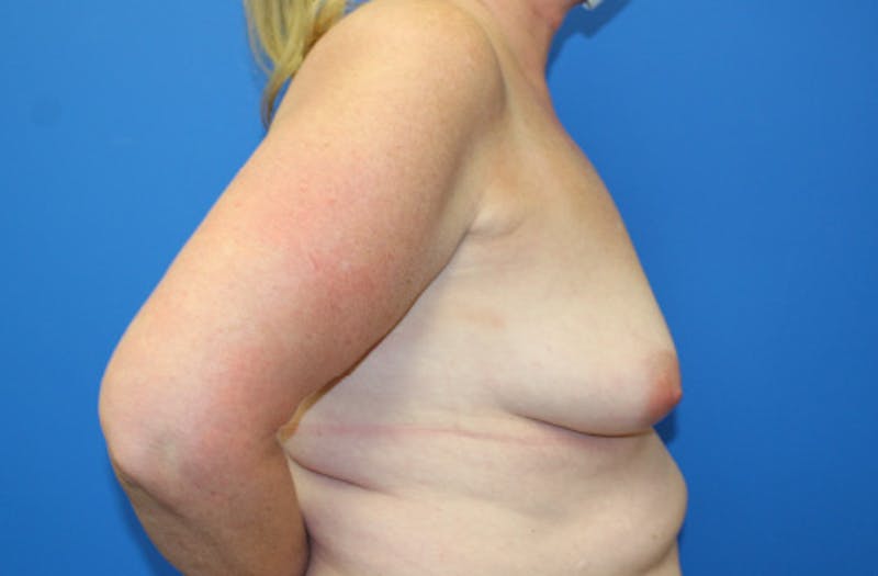 Breast Lift With Augmentation Before & After Gallery - Patient 418098 - Image 5
