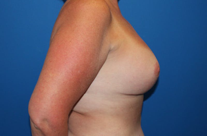 Breast Lift With Augmentation Before & After Gallery - Patient 418098 - Image 6