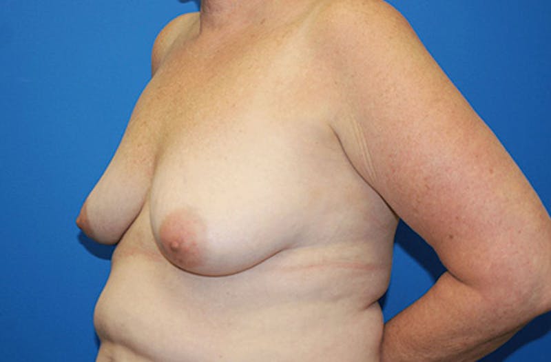 Breast Lift With Augmentation Before & After Gallery - Patient 418098 - Image 7