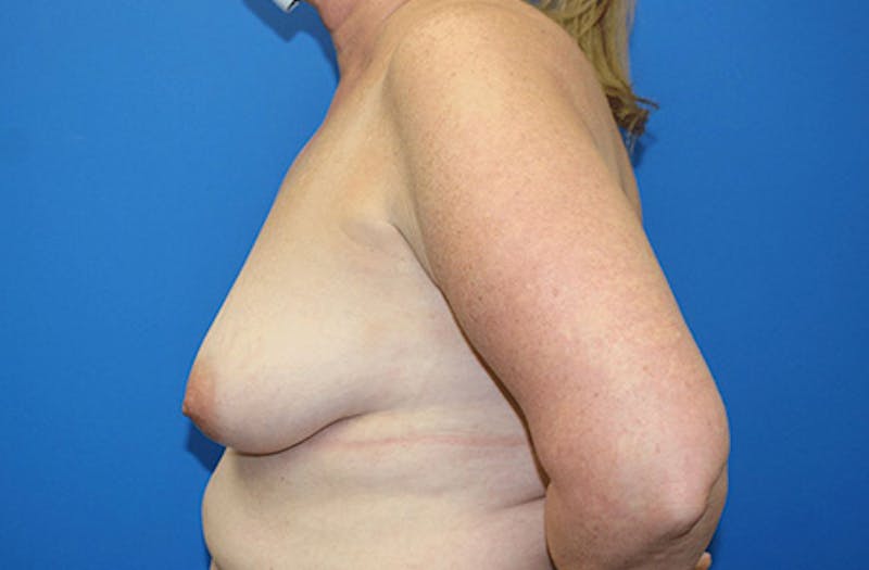 Breast Lift With Augmentation Before & After Gallery - Patient 418098 - Image 9
