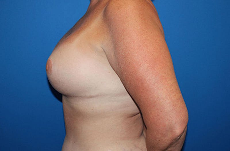 Breast Lift With Augmentation Before & After Gallery - Patient 418098 - Image 10
