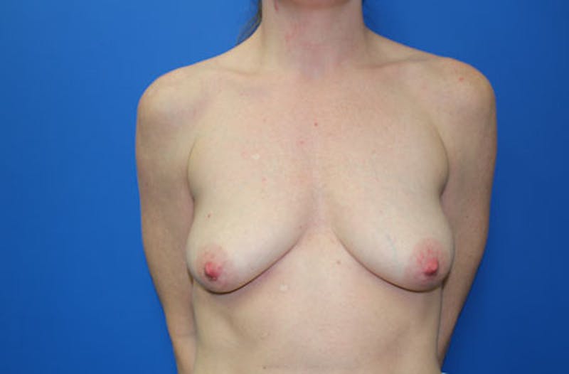 Breast Lift With Augmentation Before & After Gallery - Patient 299250 - Image 1
