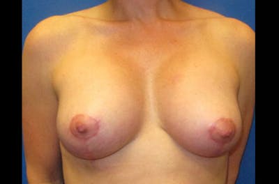 Breast Lift With Augmentation Before & After Gallery - Patient 149839 - Image 2