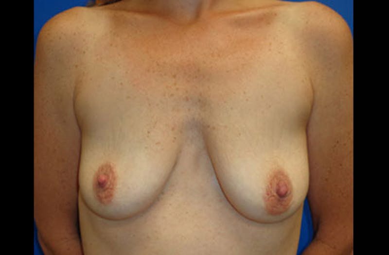 Breast Lift With Augmentation Before & After Gallery - Patient 381860 - Image 1