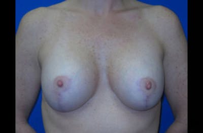 Breast Lift With Augmentation Before & After Gallery - Patient 381860 - Image 2