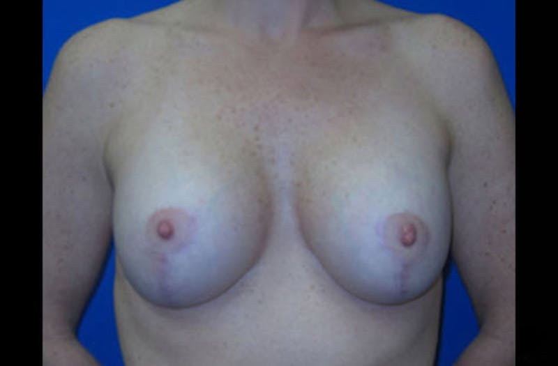Breast Lift With Augmentation Before & After Gallery - Patient 381860 - Image 2