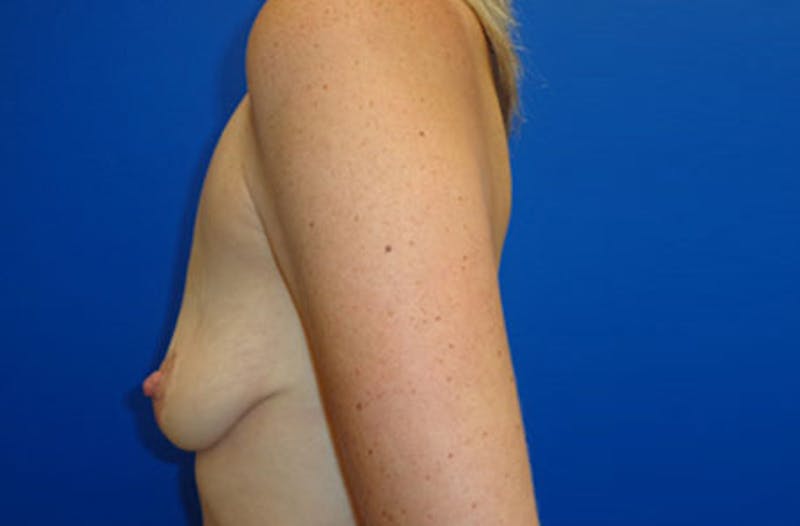 Breast Lift With Augmentation Before & After Gallery - Patient 381860 - Image 3