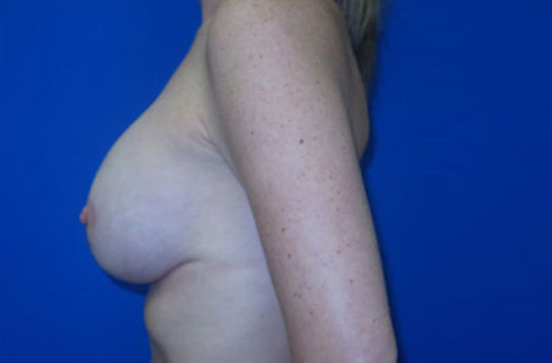 Breast Lift With Augmentation Before & After Gallery - Patient 381860 - Image 4