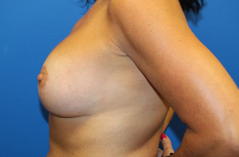 Breast Lift With Augmentation Before & After Gallery - Patient 306671 - Image 6