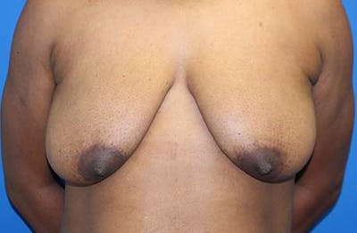 Breast Lift Before & After Gallery - Patient 288252 - Image 1