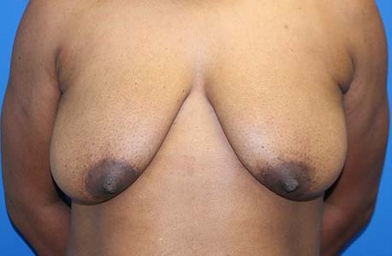 Breast Lift Before & After Gallery - Patient 288252 - Image 1
