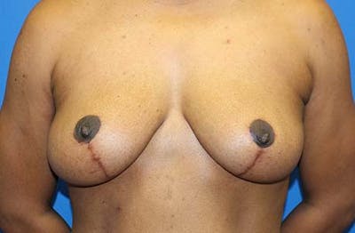 Breast Lift Before & After Gallery - Patient 288252 - Image 2
