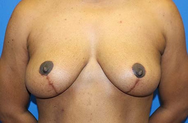 Breast Lift Before & After Gallery - Patient 288252 - Image 2