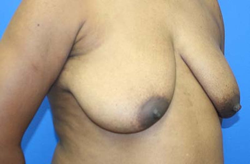 Breast Lift Before & After Gallery - Patient 288252 - Image 3