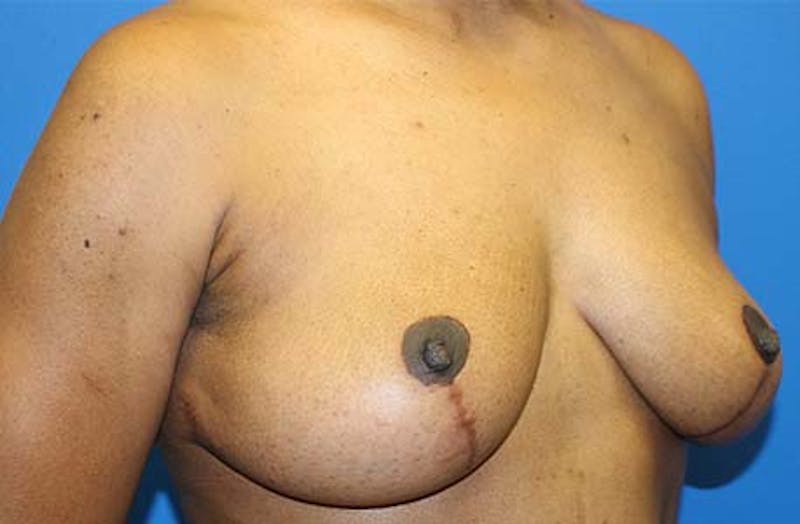 Breast Lift Before & After Gallery - Patient 288252 - Image 4