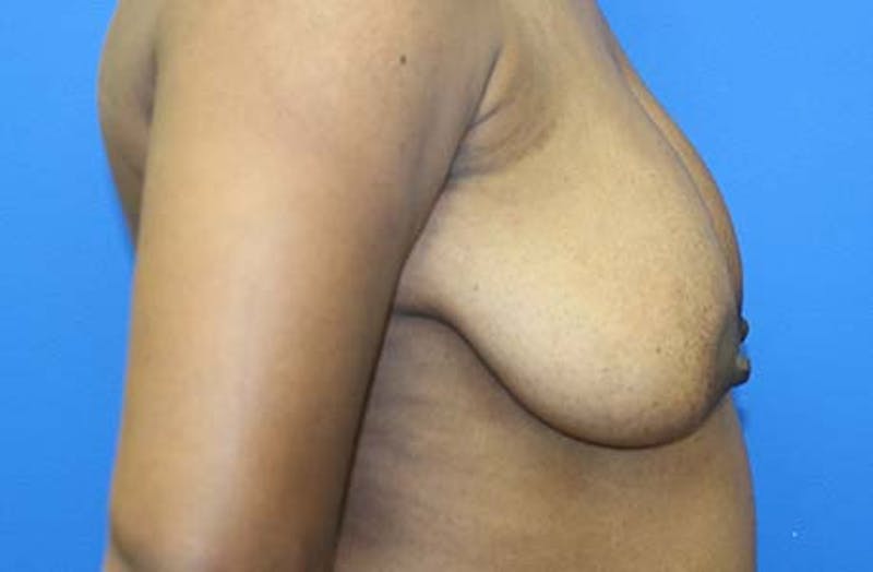 Breast Lift Before & After Gallery - Patient 288252 - Image 5