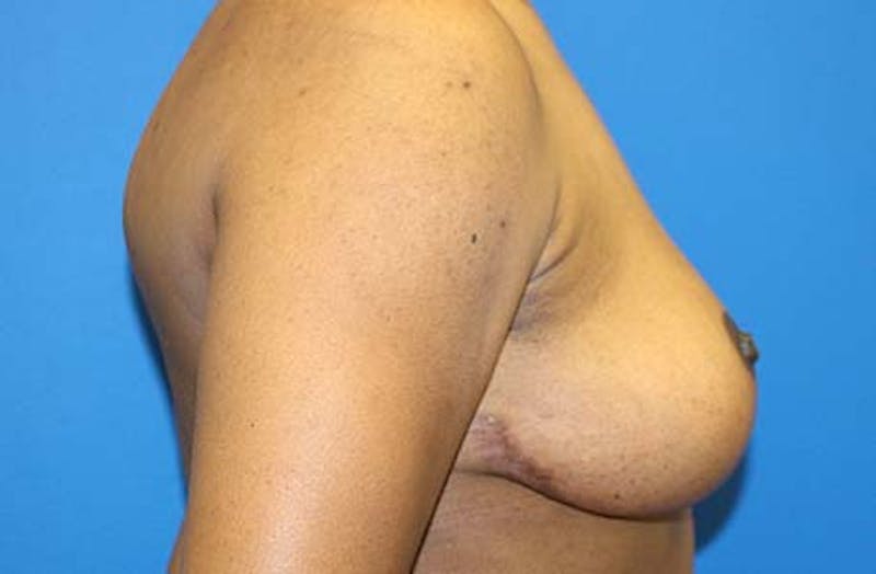Breast Lift Before & After Gallery - Patient 288252 - Image 6