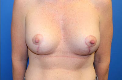 Breast Lift Before & After Gallery - Patient 152946 - Image 2