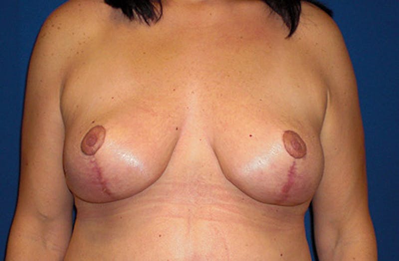 Breast Lift Before & After Gallery - Patient 195398 - Image 2