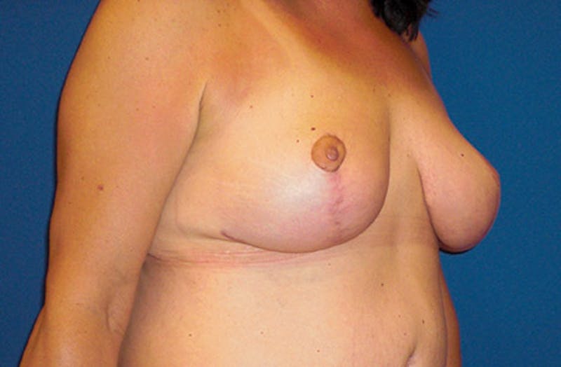 Breast Lift Before & After Gallery - Patient 195398 - Image 4
