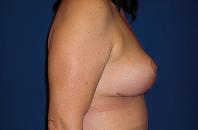 Breast Lift Before & After Gallery - Patient 195398 - Image 6