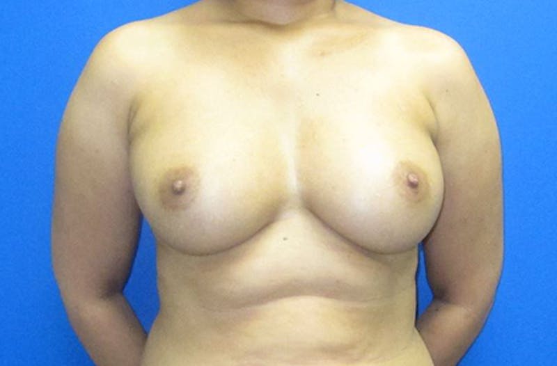 Breast Reconstruction Before & After Gallery - Patient 368493 - Image 1