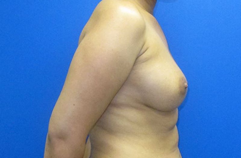 Breast Reconstruction Before & After Gallery - Patient 368493 - Image 5