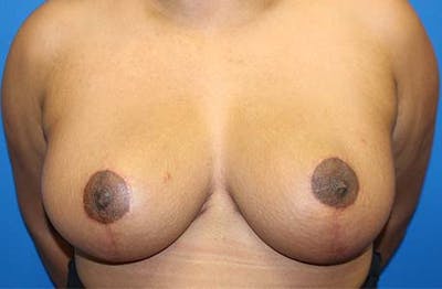 Breast Reduction Before & After Gallery - Patient 745739 - Image 2