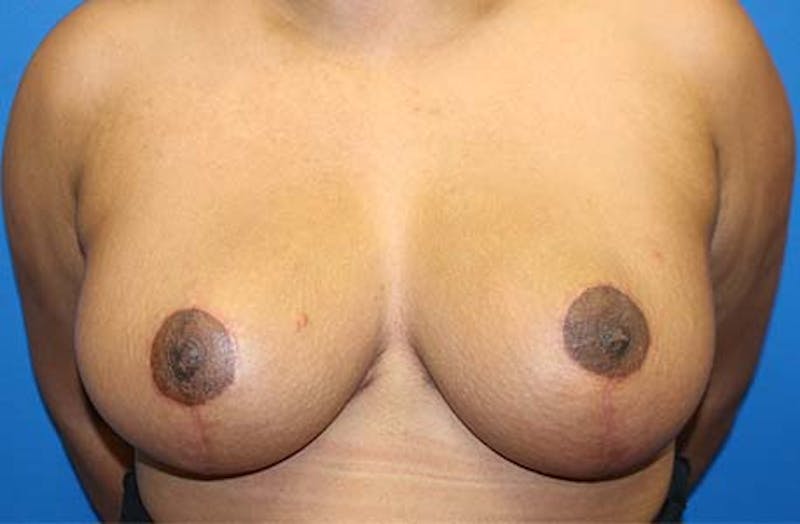 Breast Reduction Before & After Gallery - Patient 745739 - Image 2