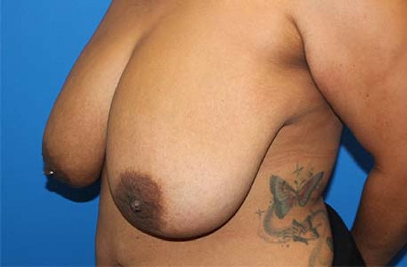 Breast Reduction Before & After Gallery - Patient 745739 - Image 3