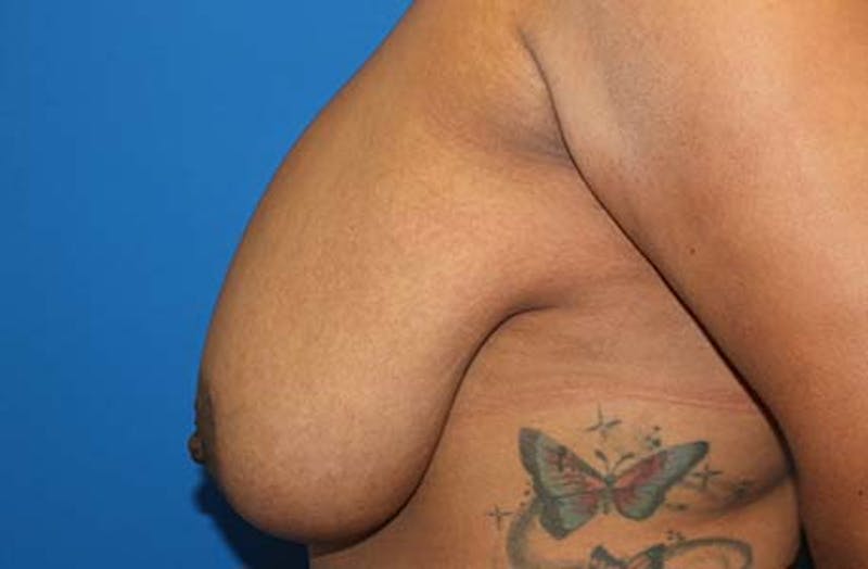 Breast Reduction Before & After Gallery - Patient 745739 - Image 5