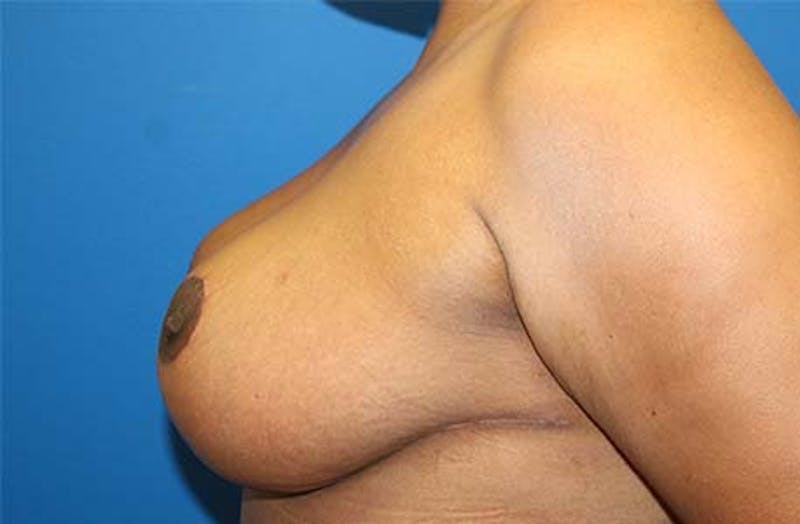 Breast Reduction Before & After Gallery - Patient 745739 - Image 6