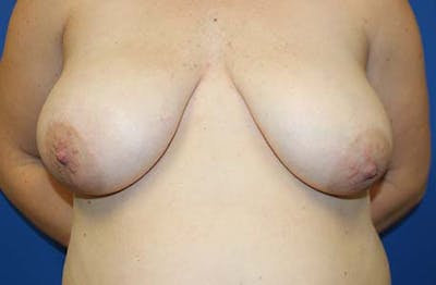 Breast Reduction Before & After Gallery - Patient 108972 - Image 1