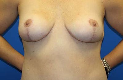Breast Reduction Before & After Gallery - Patient 108972 - Image 2