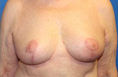 Breast Reduction Before & After Gallery - Patient 254969 - Image 2