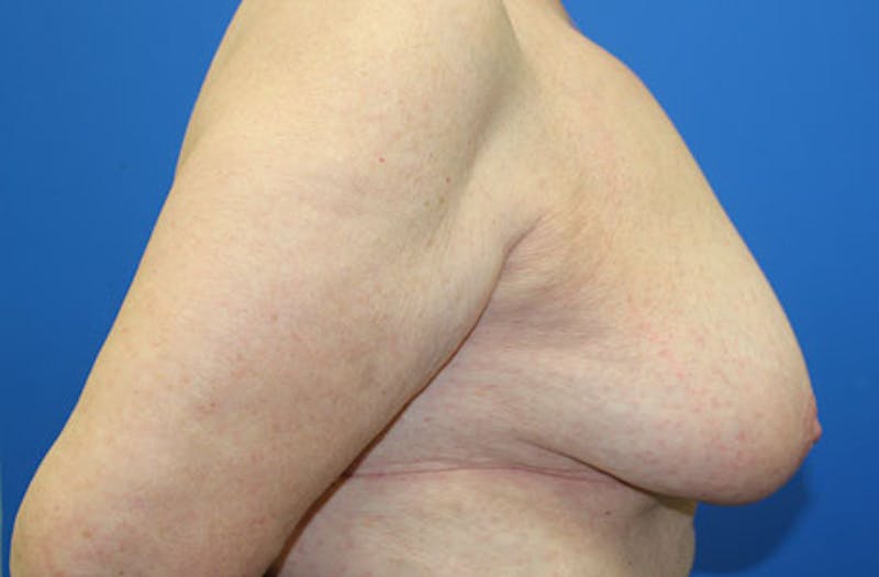 Breast Reduction Before & After Gallery - Patient 254969 - Image 3