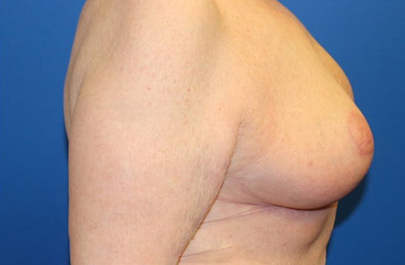 Breast Reduction Before & After Gallery - Patient 254969 - Image 4