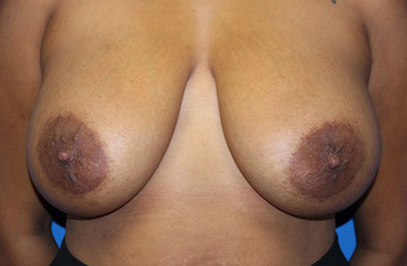 Breast Reduction Before & After Gallery - Patient 334117 - Image 1