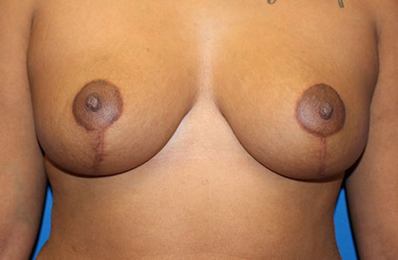Breast Reduction Before & After Gallery - Patient 334117 - Image 2