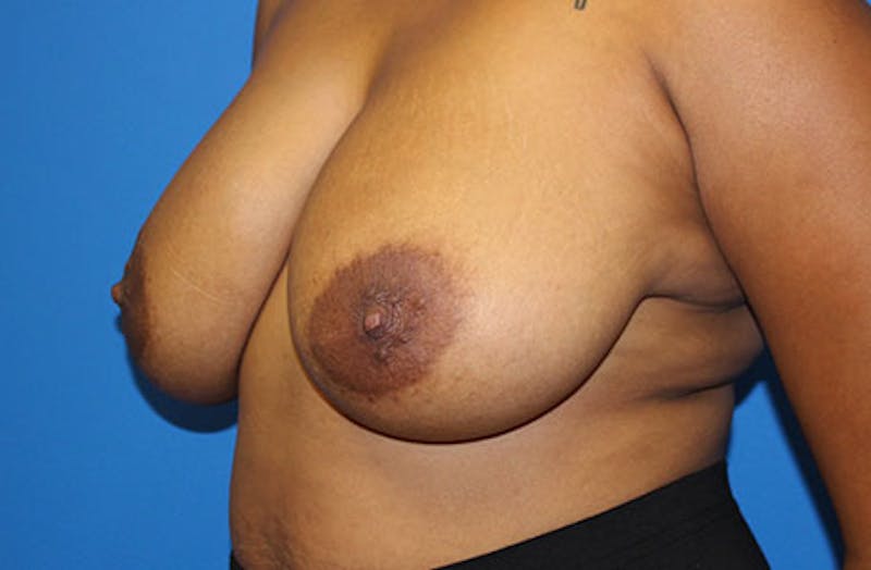 Breast Reduction Before & After Gallery - Patient 334117 - Image 3
