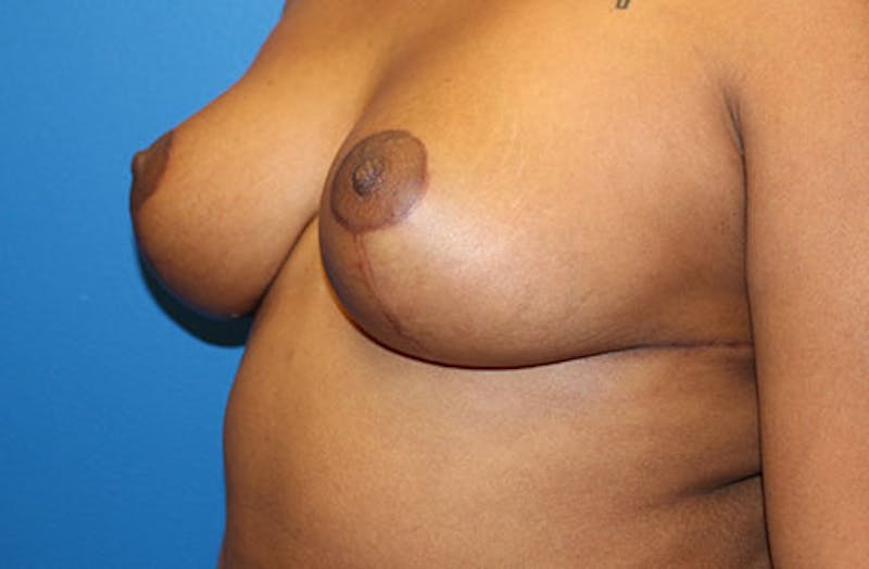 Breast Reduction Before & After Gallery - Patient 334117 - Image 4