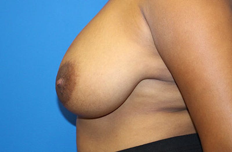Breast Reduction Before & After Gallery - Patient 334117 - Image 5