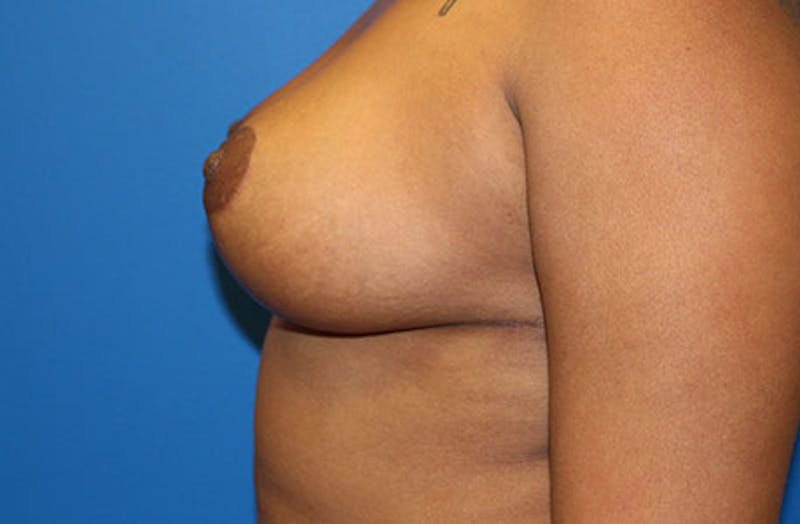 Breast Reduction Before & After Gallery - Patient 334117 - Image 6